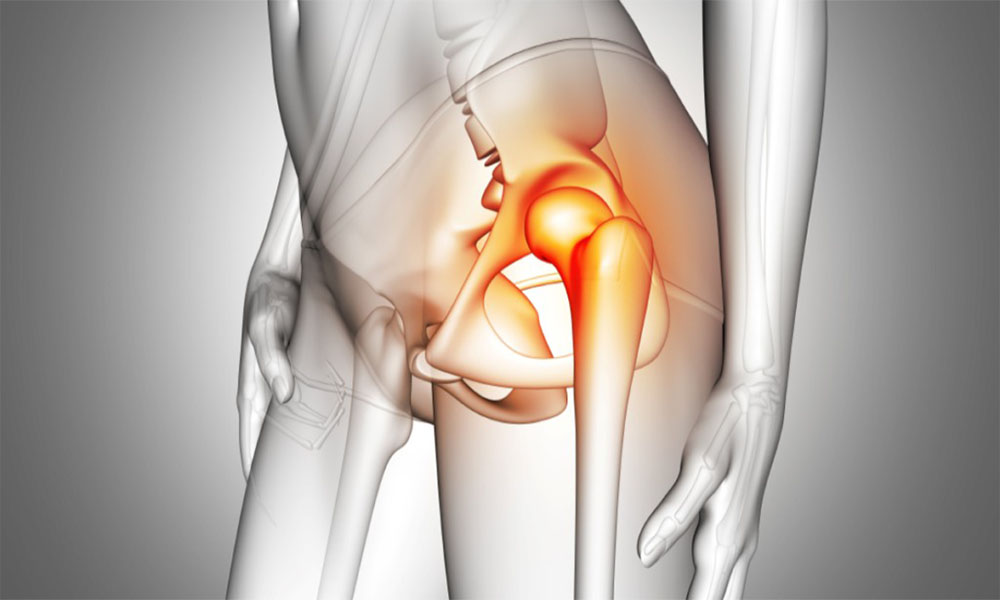 Parsiyel Kalça Protezi Nedir?