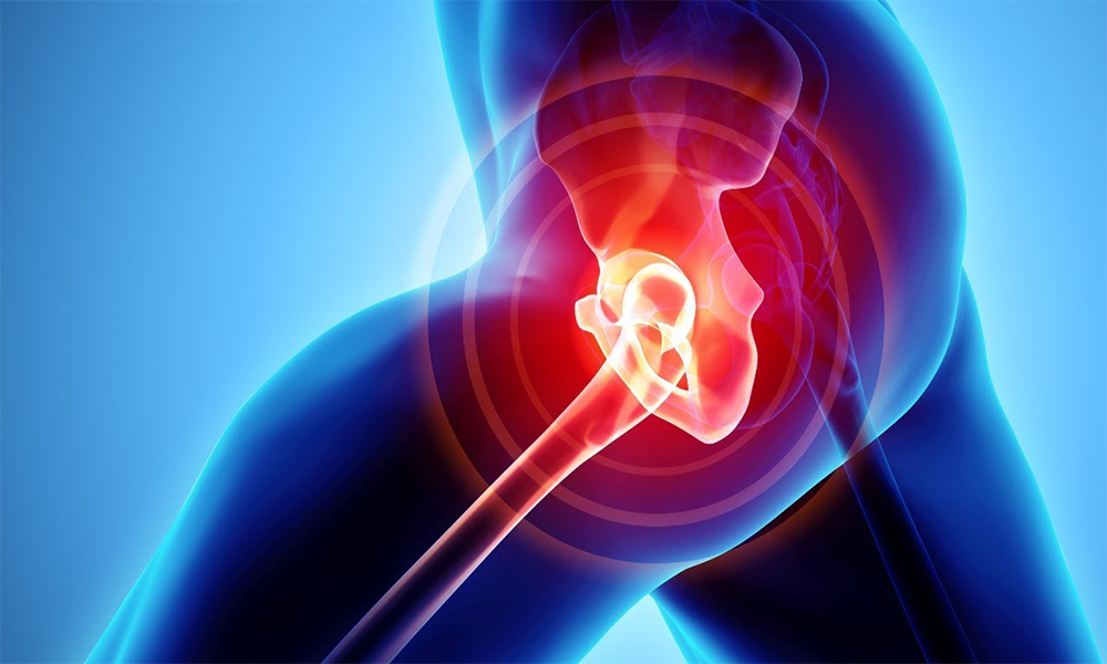 Kalça Kireçlenmesi Ameliyatı