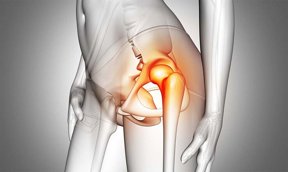 Kalça Çıkığı Ameliyatı